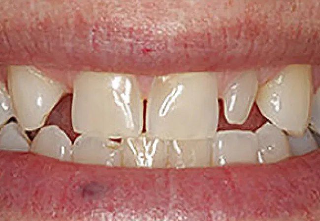 Close-up of a mouth with chipped, uneven, and discolored front teeth and a small bruise on the lower lip