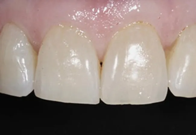 Close-up of upper front teeth showing natural enamel texture and healthy pink gums.