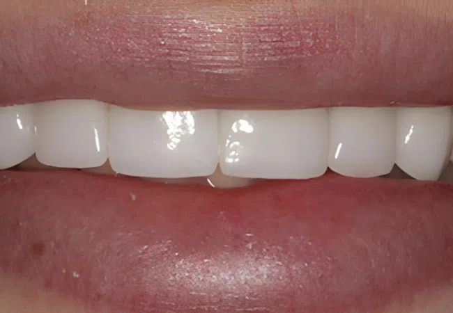 Close-up of a smile showing clean, white, evenly aligned upper front teeth with natural lips.
