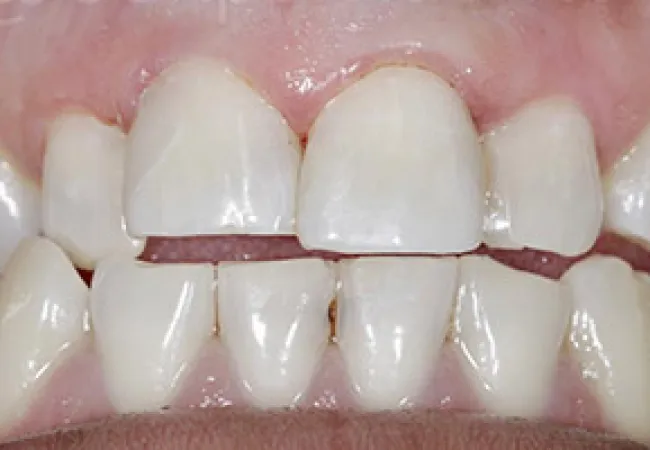 Close-up of human teeth showing gaps and slight misalignment with healthy pink gums visible.