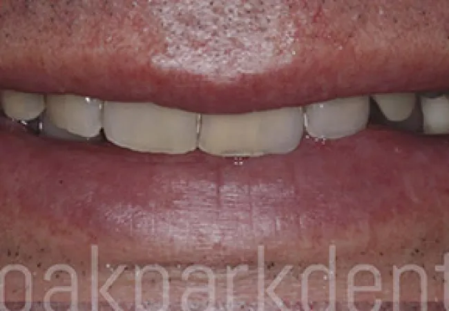 Close-up of a person's mouth showing teeth with noticeable discoloration and dental imperfections.