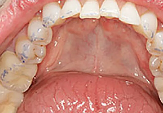 Close-up of upper teeth and palate with dental plaque disclosing agent highlighting plaque areas in blue.