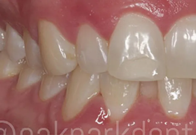Close-up of human teeth showing clear dental crowding and misalignment in the lower and upper jaw.