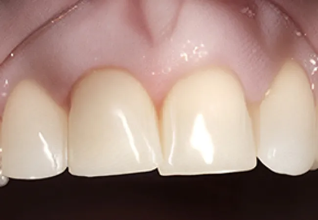 Close-up of upper front teeth showing dental veneers being checked with a dental tool for fit and finish.