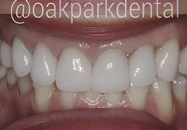 Close-up of a smile showing clean, white dental veneers on upper front teeth.