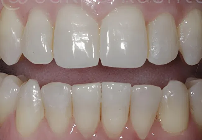 Close-up of upper and lower teeth showing dental alignment and enamel surface details