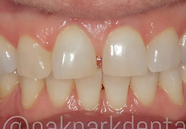Close-up of natural teeth showing slight spacing and healthy gums under bright light.