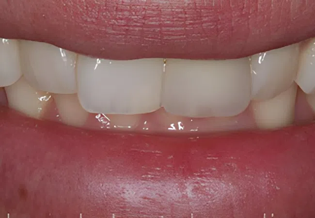 Close-up of a person's mouth showing white, straight upper front teeth and natural lips.