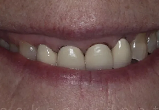 Close-up of a person's smile showing upper front teeth with dental crowns and natural teeth.