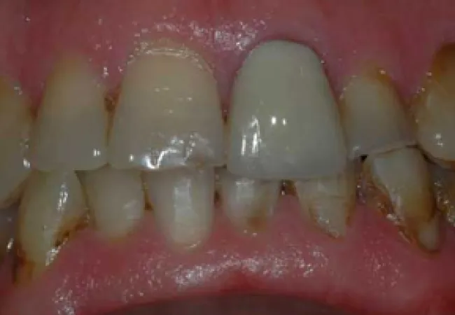 Close-up of teeth with severe tartar buildup, discoloration, and plaque affecting gum health