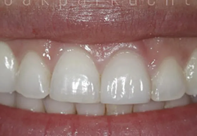 Close-up of a smiling mouth showing clean, white, evenly shaped front teeth and healthy gums