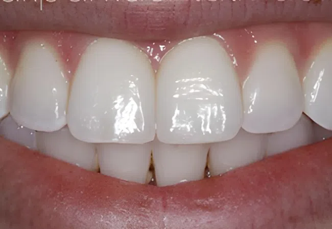 Close-up of a healthy smile showcasing clean, white teeth and natural gums in a bright close-up image