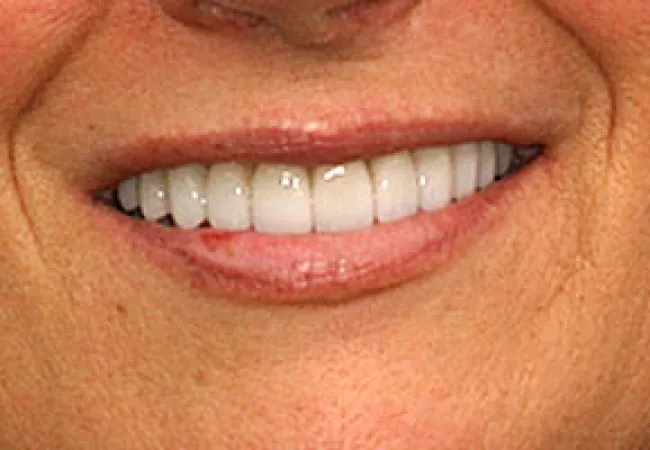 Close-up of a smiling person's mouth showing clean, white teeth and natural lip texture.