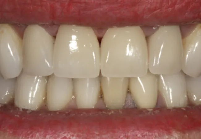 Close-up of a smile showing upper and lower teeth with slight discoloration and natural texture