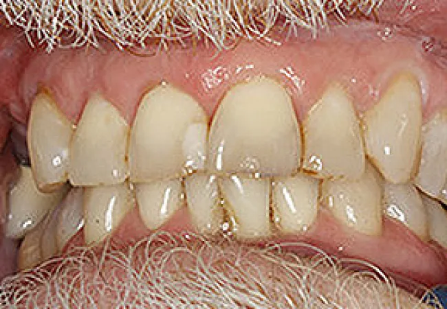 Close-up of discolored, misaligned teeth with dental plaque and visible gum tissue around mouth.