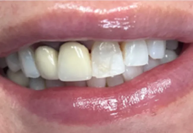 Close-up of smiling mouth showing natural and discolored, uneven teeth with dental imperfections