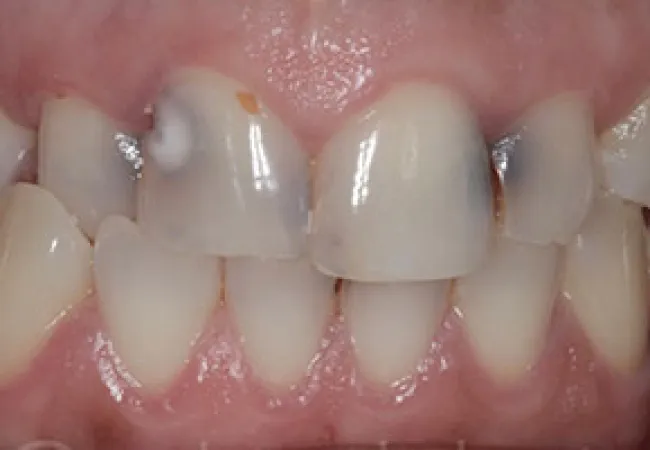 Close-up of teeth showing dental decay and discoloration on several upper front teeth with gum tissue.
