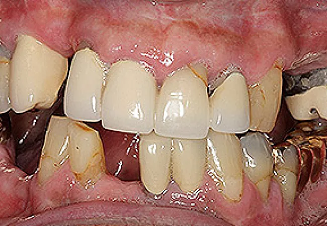 Close-up of damaged, decayed, and metal-crowned teeth with visible dental issues and gum inflammation.