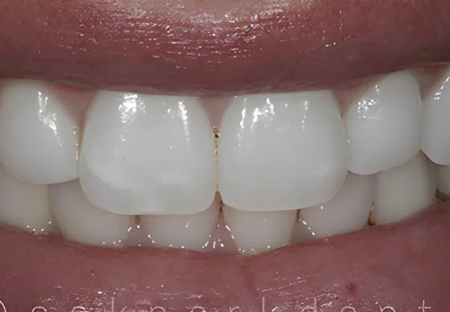 Close-up of a smile showing clean, white teeth and healthy gums with lips slightly parted