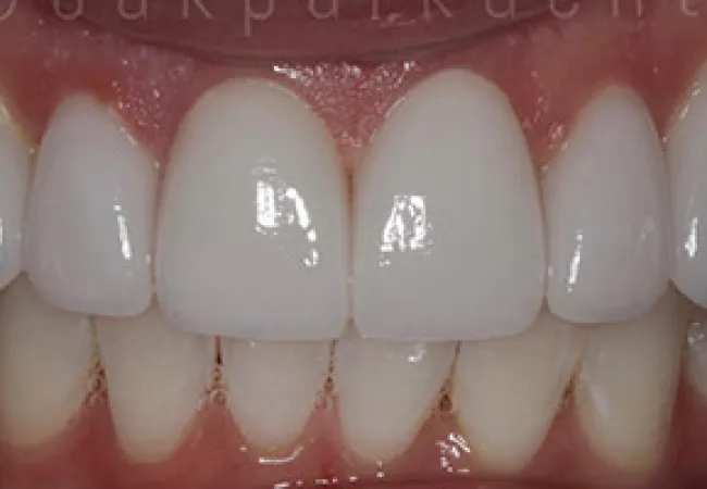 Close-up of teeth showing bright white dental veneers on upper front teeth with natural lower teeth.