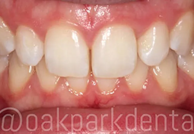 Close-up of healthy upper and lower teeth with slight crowding and pink gums.