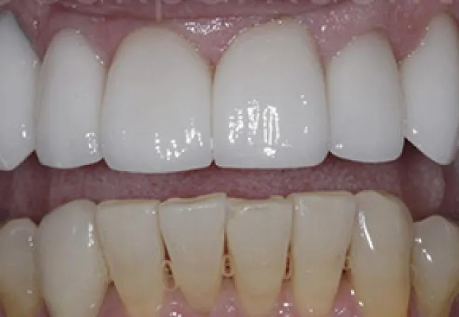 Comparison of upper teeth with bright white veneers and lower natural yellowed teeth showing dental transformation.