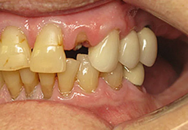 Close-up of stained and misaligned teeth with dental decay and gum issues in an open mouth.