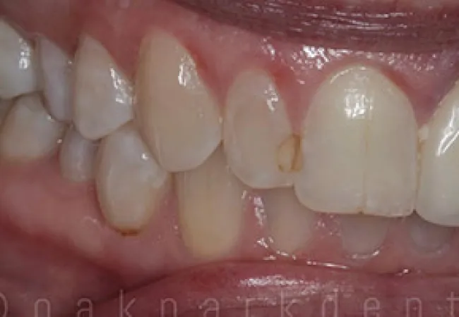 Close-up of teeth showing dental decay and discoloration on upper front teeth and gums.
