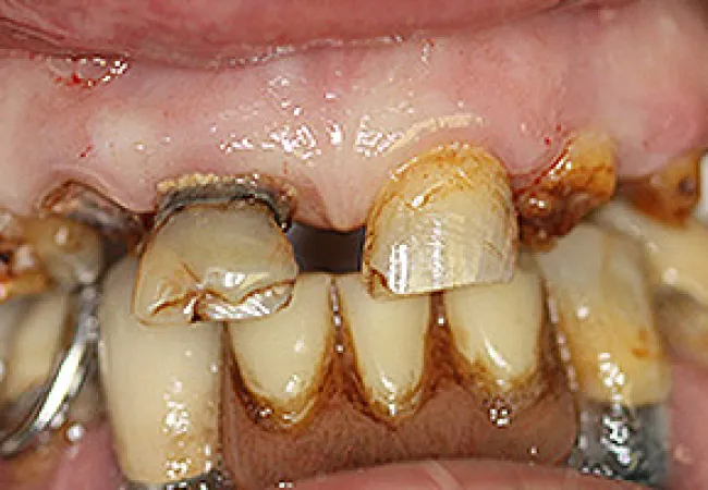 Close-up of severely decayed, cracked, and discolored teeth with visible gum disease and dental damage.