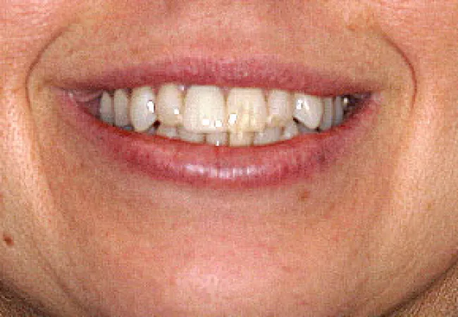 Close-up of a smiling woman showing teeth with visible discoloration and wearing silver earrings.