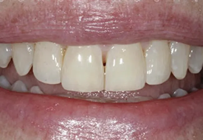 Close-up of a person's mouth showing slightly yellowed teeth with small gaps and natural lips.
