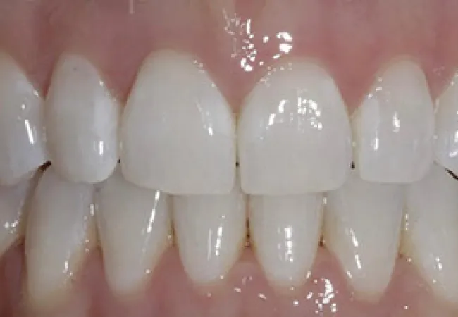 Close-up of clean, well-aligned white teeth and healthy pink gums showing a natural smile.