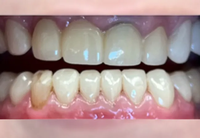 Close-up of human teeth showing natural color variation with one discolored lower tooth.