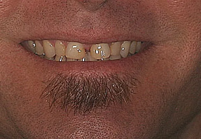Close-up of a man's mouth with stained and broken teeth and a small patch of facial hair on the chin.