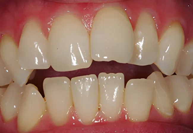 Close-up of upper and lower human teeth with visible gaps and healthy pink gums.
