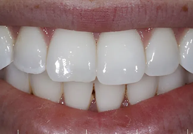 Close-up of a bright, white, healthy smile with aligned teeth and natural gums.