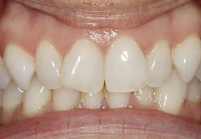 Close-up of a person's teeth showing dental crowding and misalignment with slight plaque buildup.