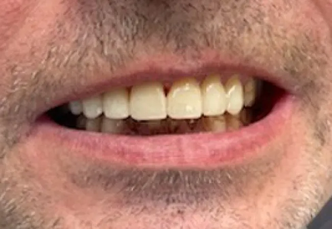 Close-up of a middle-aged man's mouth showing uneven and discolored teeth with facial hair stubble.