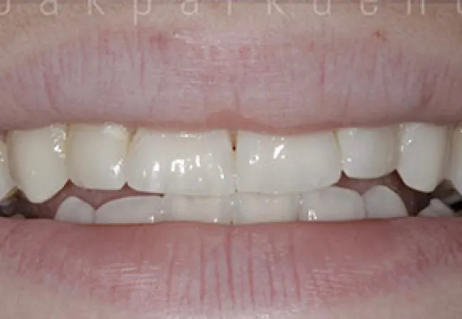 Close-up of a slightly open mouth showing natural teeth with small gaps and minimal discoloration.