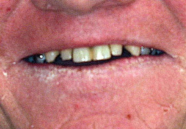 Close-up of an older person's mouth showing yellowed, missing, and crooked teeth with dry skin around lips.