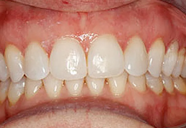 Close-up of healthy white teeth and pink gums with slight yellowing near the molars and clean dental alignment.