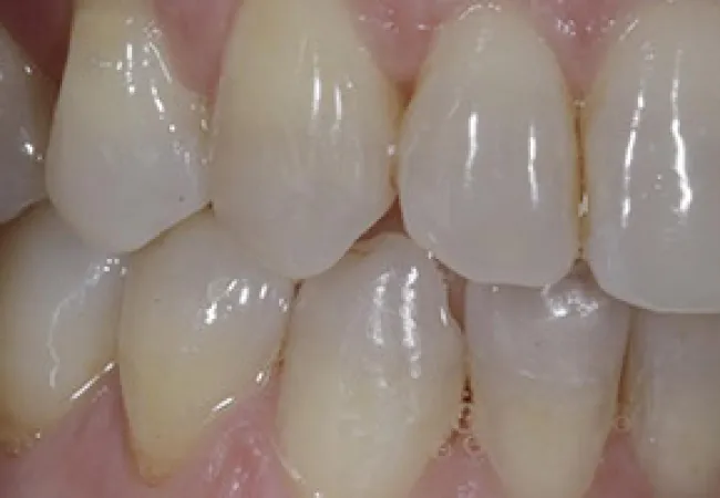Close-up of clean, healthy upper and lower teeth showing natural color and texture in the mouth.