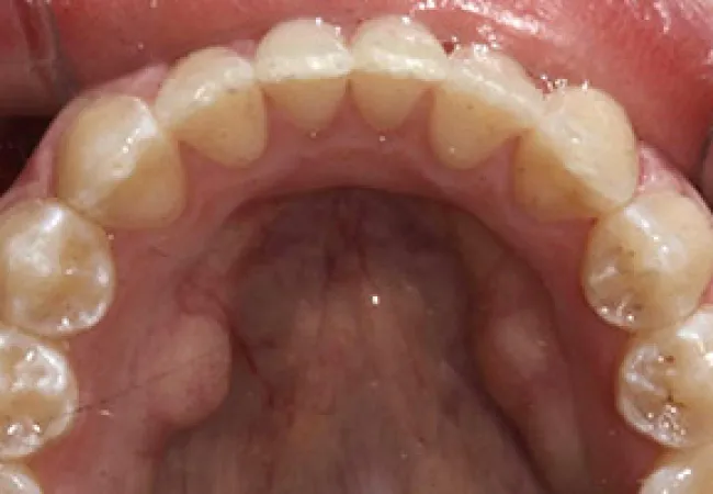 Close-up image of upper dental arch showing natural teeth and gums from inside the mouth.