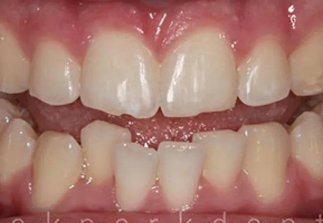 Close-up of teeth with dental misalignment showing uneven and crowded lower front teeth.