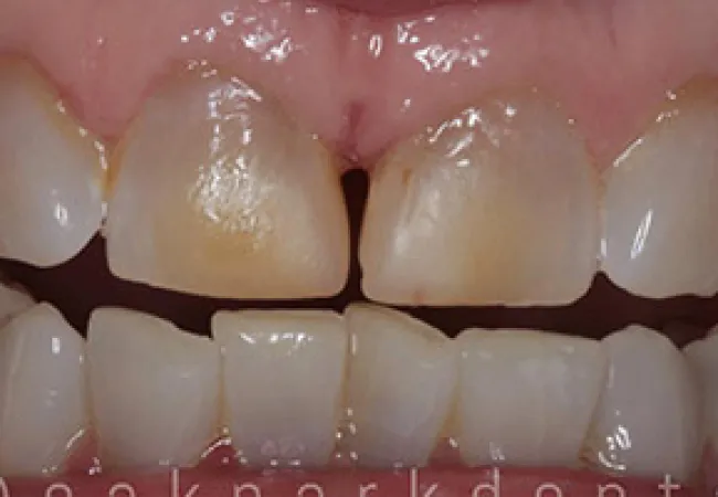 Close-up of teeth with visible discoloration and gaps between upper front teeth.