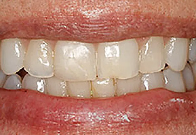Close-up image of a human mouth showing teeth with discoloration and dental plaque buildup.