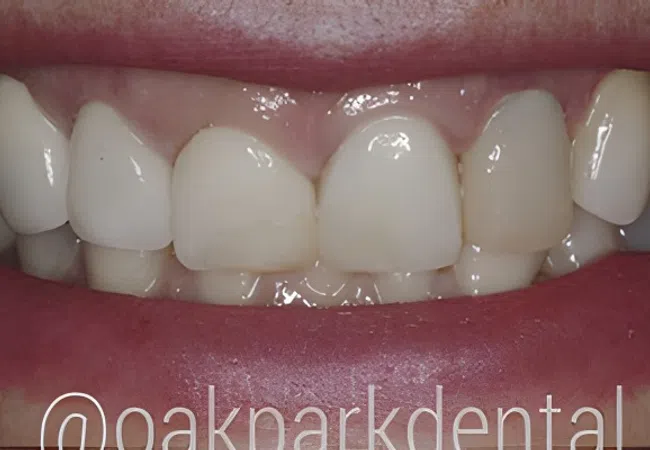 Close-up of a dental smile showing clean, white teeth and healthy gums.
