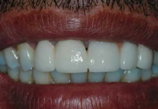 Close-up of a smiling mouth showing clean white teeth and dark lips with facial hair above.