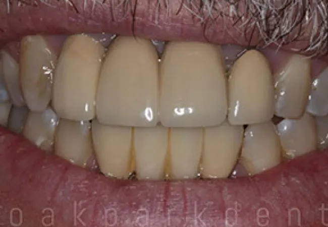Close-up of an older person's mouth showing natural and dental crown teeth with visible discoloration and wear.