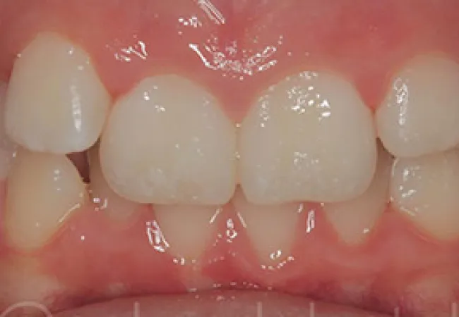 Close-up of human teeth showing dental crowding and misalignment in the lower and upper jaws